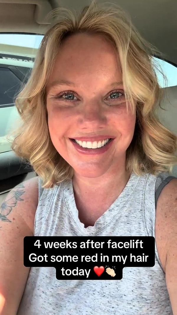 Ameliyat öncesi boyun bölgesindeki sarkmalar, düşük göz kapakları ve kırışıklıklar onu rahatsız ediyordu.