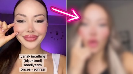 Yanak İnceltme Operasyonu Geçiren Bir Kadın Yaşadığı Değişimi Paylaştı