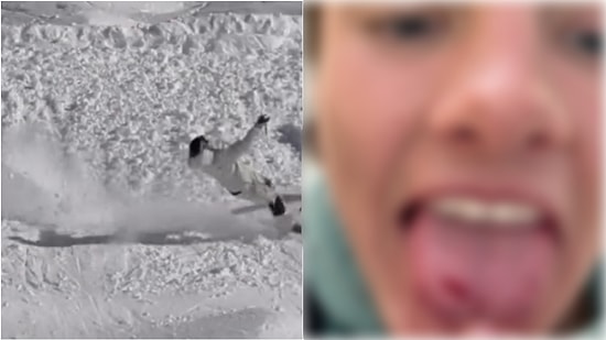Skier Shares Shocking State of Tongue After Crash for Not Wearing Mouthguard