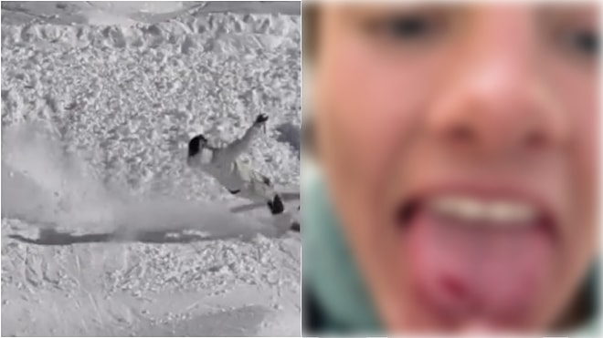 Skier Shares Shocking State of Tongue After Crash for Not Wearing Mouthguard