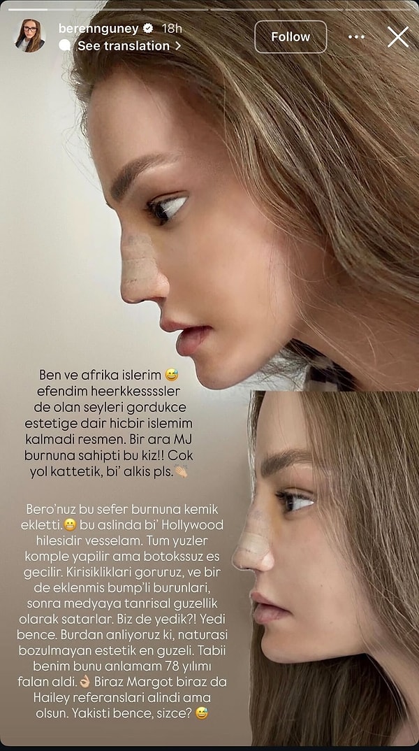 We previously had a conversation with Beren Güney about her gender transition process. Now, however, the topic at hand is entirely different: rhinoplasty.