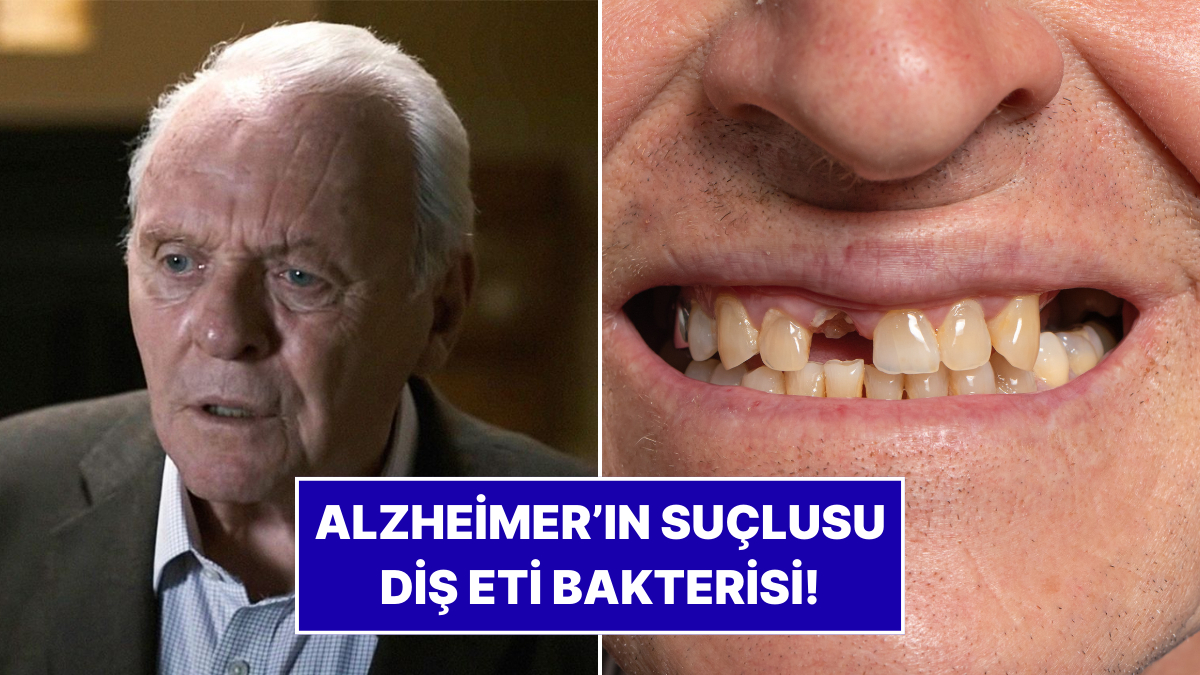 Uzmanlardan Şaşırtan Araştırma: Alzheimer’ın Kaynağı Diş Eti Bakterisi Olabilir!