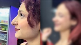 A Woman Who Underwent Rhinoplasty Shared The Transformation She Experienced