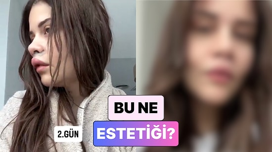 Yine Yeni Bir Estetik Trendi: Dudak Kaldırma Operasyonu Geçiren Kadın Yaşadığı Değişimi Paylaştı