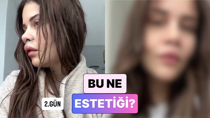 Yine Yeni Bir Estetik Trendi: Dudak Kaldırma Operasyonu Geçiren Kadın Yaşadığı Değişimi Paylaştı