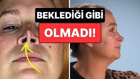 Başarısız Burun Ameliyatı Düğün Hayallerini Suya Düşürdü: "Çizgi Film Karakterlerine Benzedim"