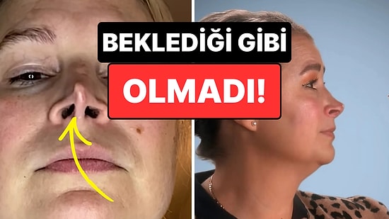 Başarısız Burun Ameliyatı Düğün Hayallerini Suya Düşürdü: "Çizgi Film Karakterlerine Benzedim"