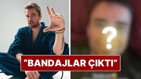 Murat Dalkılıç 13. Ameliyat Sonrası Burnunun Son Halini Paylaştı