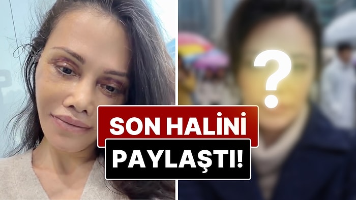 Didem Ceran 48 Saat Süren Estetik Operasyonu Sonrası Yüzünün Değişimini Paylaştı!