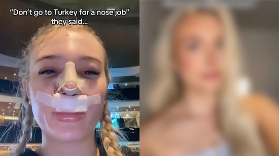 Woman Who Ignored Advice Not To Get Rhinoplasty In Turkey Shares Her Transformation To Prove Her Critics Wrong