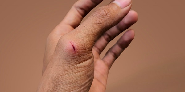 6. Küçük kesiklerin hızla iyileşmesi.