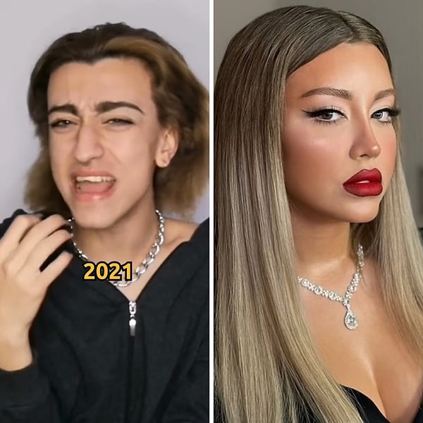 Mika Raun’un estetik süreciyle ilgili bugüne kadar pek çok iddia ortaya atılmıştı ancak ilk kez doktoru Selim Turan, yapılan işlemleri detaylı şekilde anlattı.