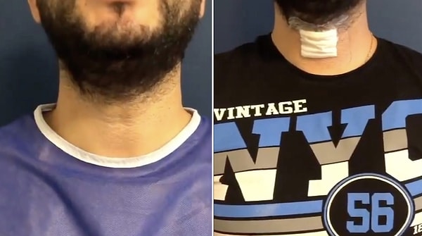 This Man’s Voice Deepening Surgery Went Viral! You Won't Believe the Difference in His New Deep Voice