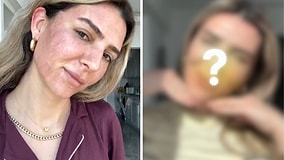 Merve Aydın Reveals Her Look After Laser Treatment