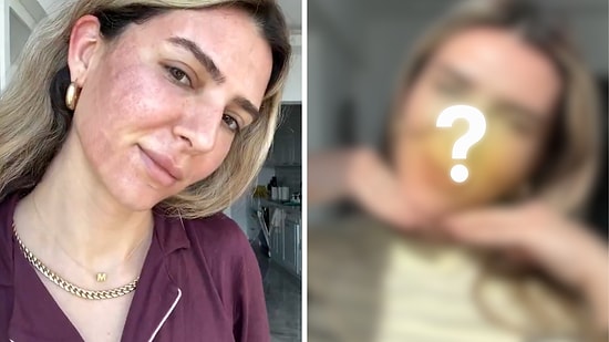Merve Aydın Reveals Her Look After Laser Treatment
