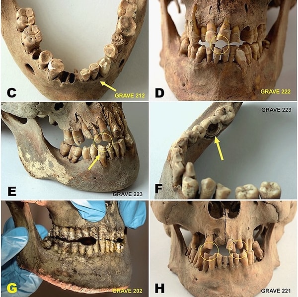 In the vast majority of the skeletons examined, scurvy, a disease resulting from a deficiency of vitamin C and the bane of sailors of the time, was identified.