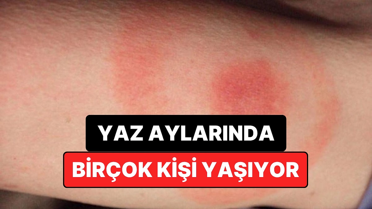 Uzmanlar Uyarıyor: Yaz Aylarında Sessizce Artan Bu Hastalığa Karşı Tedbirli Olun