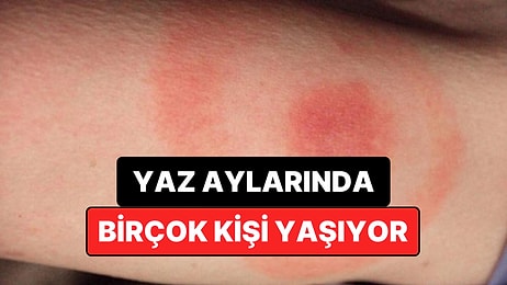 Uzmanlar Uyarıyor: Yaz Aylarında Sessizce Artan Bu Hastalığa Karşı Tedbirli Olun