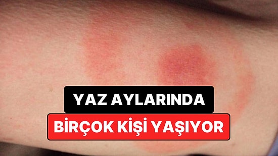 Uzmanlar Uyarıyor: Yaz Aylarında Sessizce Artan Bu Hastalığa Karşı Tedbirli Olun