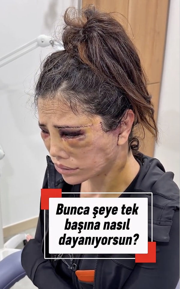 Didem Ceran, daha önce yaptığı açıklamalarla ve Kore'de saatler süren estetik operasyonla gündemdeki yerini korumaya devam ediyor.