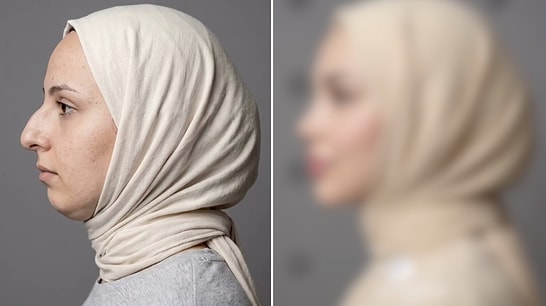 Unrecognizable Transformation: Woman Shares Her Shocking Plastic Surgery Journey