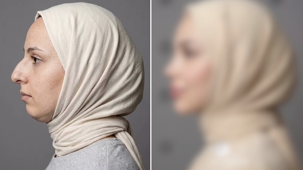 Unrecognizable Transformation: Woman Shares Her Shocking Plastic Surgery Journey