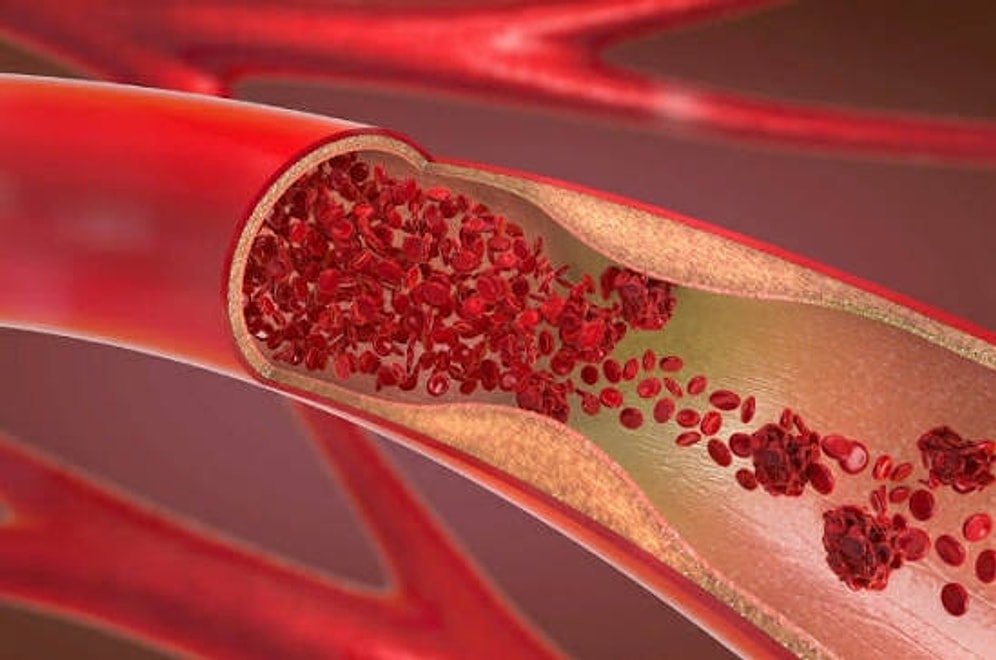 Not Red Meat or Salt: Cardiologist Reveals the Hidden Drink That Clogs Arteries