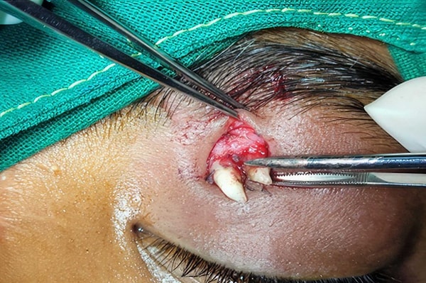 Cerrahi müdahaleyle dişin çıkarılmasının ardından bulgular teratomayı değil, ektopik dişi gösterdi.