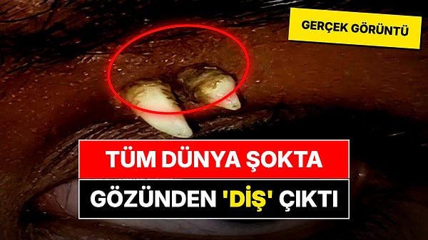 Dünyadaki İlk Vaka Olarak Tarihe Geçti!