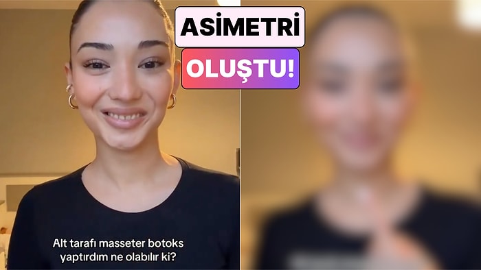 Masseter Botoksu Yaptıran Bir Kadın Yüzünde Oluşan Asimetriyi Gösterdi