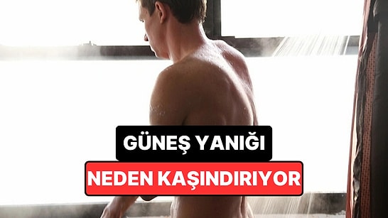 Güneş Yanığından Günler Sonra Gelen 'Cehennem Kaşıntısı' Kremle Daha da Kötüleşebiliyor