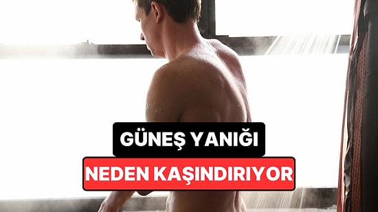 Güneş Yanığından Günler Sonra Gelen 'Cehennem Kaşıntısı' Kremle Daha da Kötüleşebiliyor