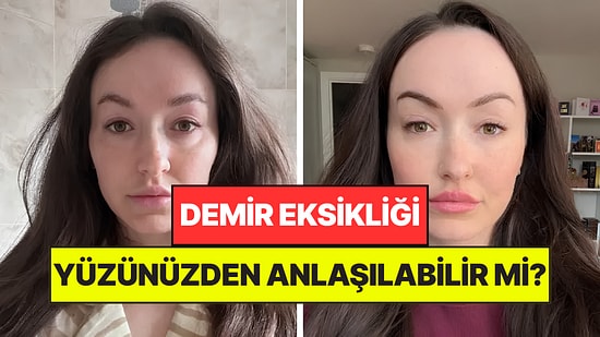 Demir Eksikliği Dış Görünüşünüzden Anlaşılabilir mi? Yeni Akım Çok Konuşuldu
