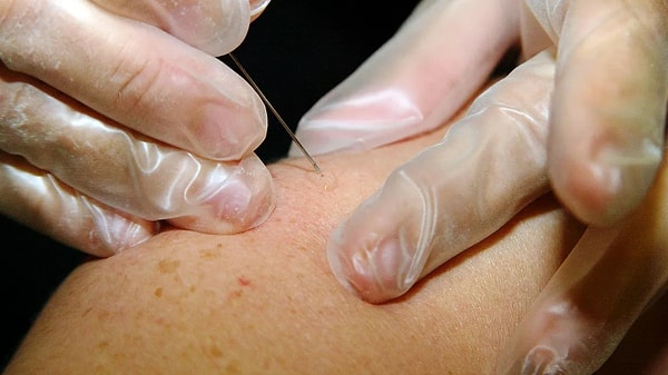 Güner, "1980 yılı öncesinde doğmuş olanlar aşılı oldukları için çiçek hastalığına karşı korunmalı. Dolayısıyla burada da çapraz bir korunma söz konusu, çiçek hastalığına karşı aşısı olanların M-çiçek hastalığından da büyük bir oranda korunduklarını söylemek mümkün." diye konuştu.